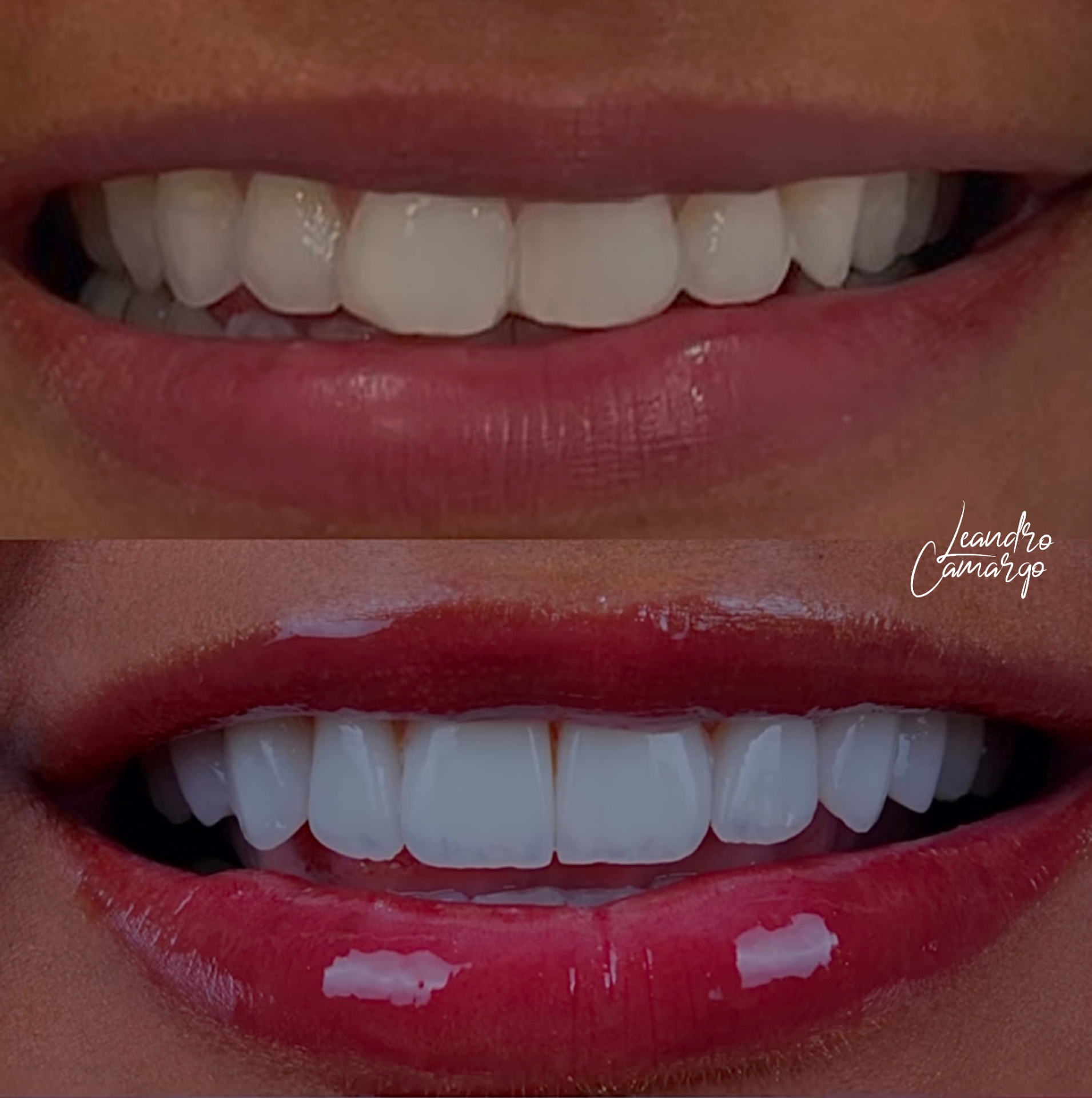 Facetas dentárias — depois