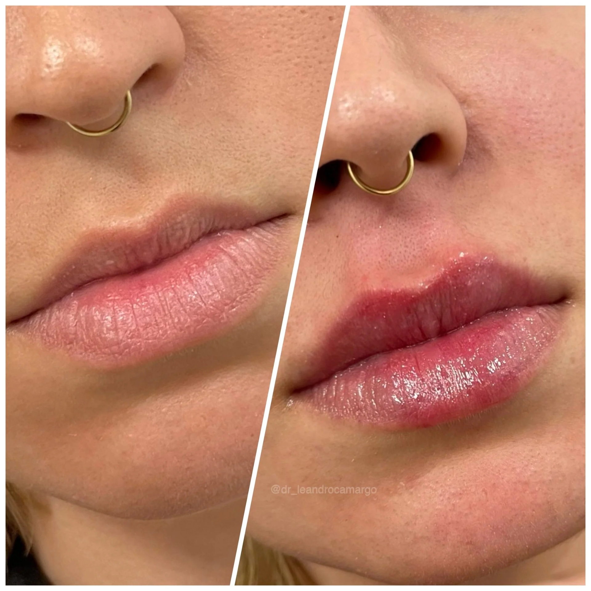 Harmonização labial — depois